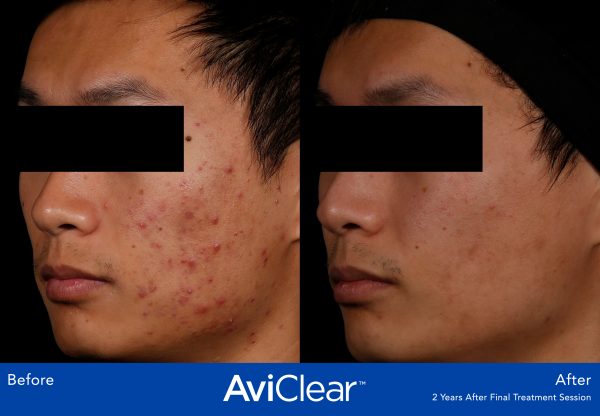 08_AviClear_BA_2-photos-600x416