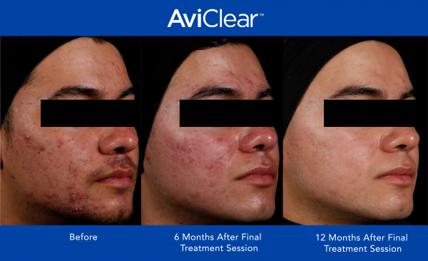 AviClear-Before-and-After-_12-month_1-600x366